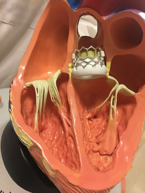 Arteries Anatomy, Heart Valves, Cardiac Sonography, Open Heart Surgery, Aortic Valve Replacement, Cardiac Nursing, Interventional Cardiology, Heart Anatomy, Coronary Arteries