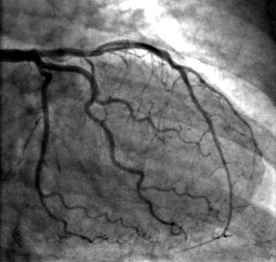 Coronary Circulation, Cardiothoracic Surgery, Blood Heart, Lymph Vessels, Gross Anatomy, Heart Valves, Coronary Arteries, Medical Imaging, Heart Surgery