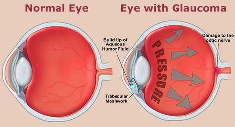 Side by side comparison of a normal eye and an eye suffering the symptoms of Glaucoma #eyehealth Eye Facts, Optic Nerve, Parts Of The Eye, Vision Loss, Vision Eye, Natural Healing Remedies, Healthy Eyes, Eyes Problems, Living Healthy