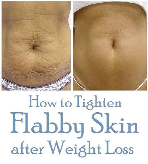 How to Tighten Flabby Skin after Weight Loss or Pregnancy Natural Skin Tightening, Mommy Workout, Sup Yoga, Body Wrap, Fitness Transformation, Skin Tightening, Diet Tips, Get In Shape, Fitness Diet