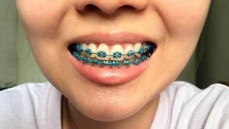 Teal Braces, Brace Colors, Braces Ideas, Ceramic Braces, Cute Braces Colors, Kids Braces, Braces Tips, Getting Braces, Braces Girls