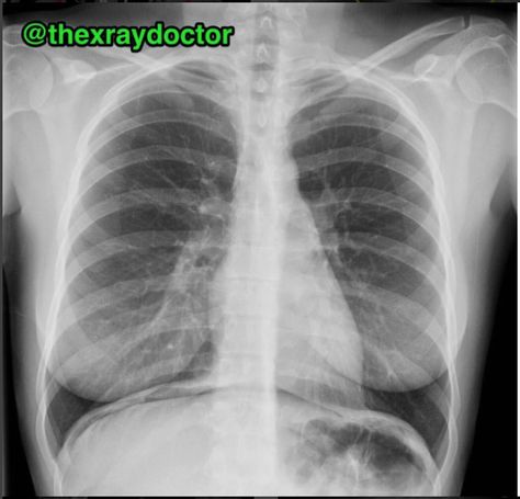 Respiratory Acidosis, Xray Art, Pleural Effusion, X-ray Images, Back Stretches For Pain, Preventative Health, Body Hair Removal, Buddha Image, Money And Happiness