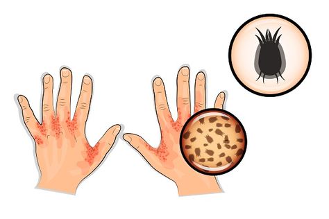 Scabies Mite: Can scabies mites be seen? What does a mite bite look like on a human? Mites On Humans, Hair Diseases, Facial Warts, Fungal Infection Skin, Unicorn Halloween, Skin Disorders, Home Remedies, Stock Vector, Geek Stuff