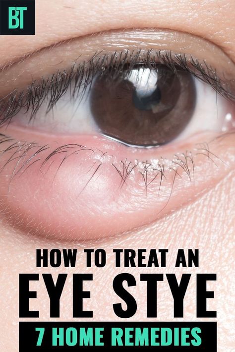 7 home remedies for an eye stye. How to treat an eye stye at home to get rid of it quickly. Read also about the causes and types of an eye stye that appears on adults and kids. Get Rid Of Stye, Stye Remedy, Eye Stye Remedies, Back Acne Remedies, Different Types Of Acne, Blind Pimple, Bad Acne, Pimples Remedies, Natural Acne Remedies