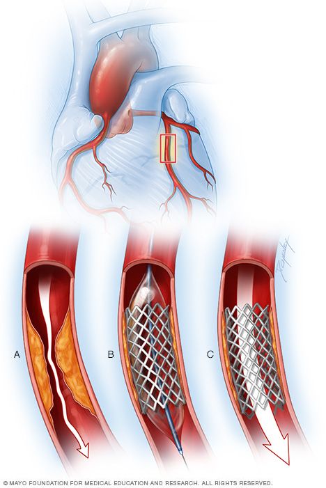 Balloon to widen a coronary artery Heart Stent, Cardiac Cath, Heart Arteries, Surgical Technician, Anatomy Physiology, Medical Videos, Heart Anatomy, Coronary Arteries, Medical Anatomy