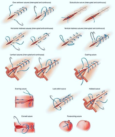 Suture Types, Medical Stitches, Surgical Stitches, Body Surgery, Surgical Suture, Medical Mnemonics, Surgical Tech, Nurse Study Notes, Biology Notes