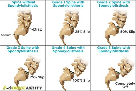 Spinal Degeneration, Spinal Fusion Surgery, Back Health, Spinal Fusion, Human Spine, Chronic Back Pain, Back Pain Remedies, Spine Health, Spine Surgery