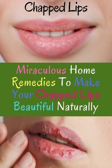 Dry Lips Remedy, Chapped Lips Remedy, Lighten Dark Lips, Dark Patches On Skin, Hydrogen Peroxide Teeth Whitening, Peroxide Teeth Whitening, Dry Cracked Lips, Healthy Book, Face Glow