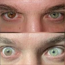 Change Eye Colour, Eye Color Change Surgery, Sectoral Heterochromia, Change Your Eye Color, Laser Eye Surgery, Laser Eye, Laser Surgery, Eye Surgery, Pregnant Diet