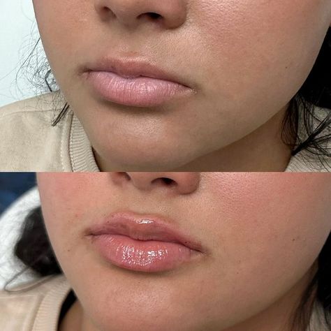 #juvaderm #lipfiller #lipplump #dermalfiller #atxmedicalspa #atxmedspa #atxinjections #atxinjectables #atxfiller #atx #austintx #texas Lip Plumper, First Time, The First, Lips