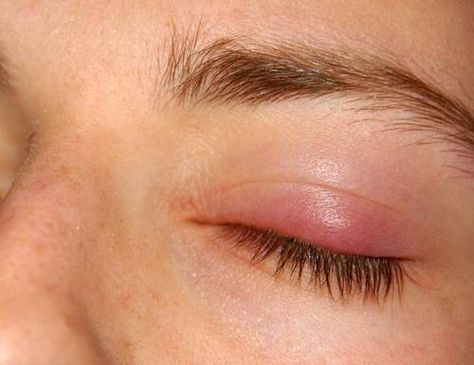 Eye Inflammation Remedies, Swollen Eye, Swollen Eyes Remedy, Eye Swelling, Eye Allergies Remedies, Stye Remedies Fast, Swollen Eyelids Remedy, Bump On Eyelid, How To Get Rid Of An Eye Infection