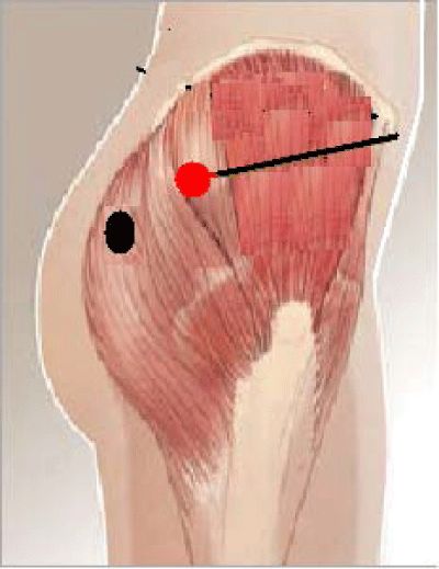 The red circular area represents the ventrogluteal injection site, while the black one represents the dorsogluteal injection point. The black line indicates the distance of the ventrogluteal site to the anterior superior Ventrogluteal Injection Site, Ventrogluteal Injection, Injection Sites, Nursing 101, Physical Rehabilitation, Trigger Point, Nursing Programs, Trigger Points, Medical Education