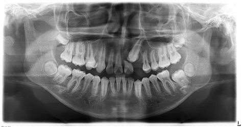 This is a radiograph of a 12 year old child showing how an impacted canine tooth #6 has resorbed and destroyed the lateral incisor #7 and the central incisor #8. This all could have been prevented if the child would have had an orthodontic evaluation around the age of 7.   Dentaltown - Who does routine radiographs... GP or Perio office? Wisdom Teeth Video, Impacted Wisdom Teeth, Sensitive Teeth Remedy, Facial Bones, Oral Maxillofacial, Dental Implants Cost, Oral Surgeon, Emergency Dentist, Teeth Implants