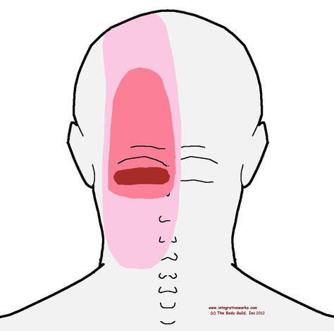 semispinalis cervicis pain Headache Back Of Head, Head Pain Relief, Forward Head Posture Exercises, Occipital Neuralgia, Natural Headache, Severe Back Pain, Natural Headache Remedies, Back Of Head, Head Pain