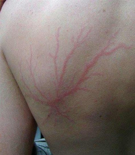 Classic Web-Like Pattern From is listed (or ranked) 7 on the list These Photos Show What Happens After You Get Struck By Lightning Struck By Lightning Scar, Lightning Scar, Lightning Photos, Lichtenberg Figures, Struck By Lightning, Lightning Strikes, Leaf Tattoos, Jesus Fish Tattoo, Triangle Tattoo