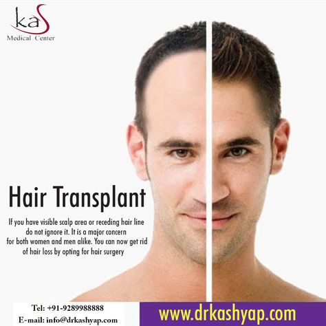 Hair Transplant Creative Ads, Receding Hair, Hair Surgery, Hair Transplant Women, Eyebrow Transplant, Receding Hair Styles, Hair Transplant Results, Ball Recipes, Fue Hair Transplant