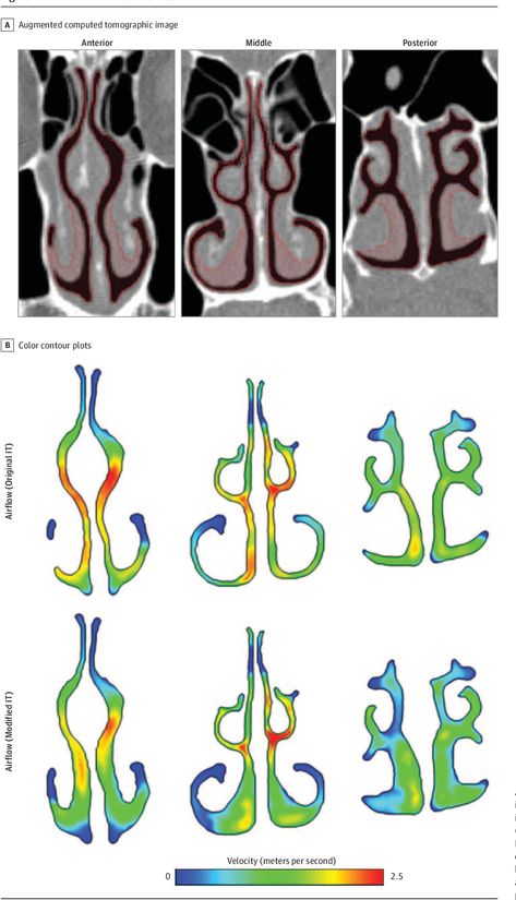 Figure 1 from Computational Fluid Dynamics to Evaluate the Effectiveness of Inferior Turbinate Reduction Techniques to Improve Nasal Airflow | Semantic Scholar Sinus Medicine, Cfd Simulation, Paranasal Sinuses, Nasal Obstruction, Computational Fluid Dynamics, Nasal Septum, Regression Analysis, Linear Regression, Sinus Pressure