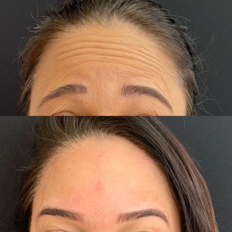 Botox Facial, Botox Before And After, Skin Care Pictures, Face Lift Surgery, Botox Face, Skin Care Business, Cosmetic Injectables, Facial Aesthetics, Botox Fillers