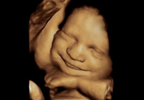 Happy smiling baby in 3D 3d Ultrasound, 4d Ultrasound, Baby Ultrasound, Ultrasound Pictures, Baby Images, Precious Memories, Ultrasound, Sweet Dreams, Gender Reveal