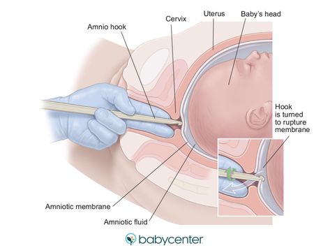 diagram of an amnio hook inserted through the cervix Checking Cervix For Dilation, Inducing Labor, Labor Induction, Anatomy Education, Pregnancy Workout Videos, Midwifery Student, Doula Training, Nursing Board, Student Midwife