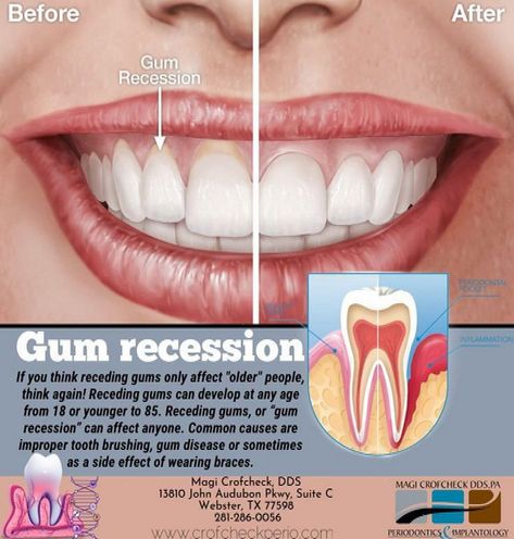 Learn effective ways to prevent gum recession and maintain optimal gum health. Discover expert tips for gum care, teeth remineralization, and preventing teeth problems. Explore natural remedies and treatments to reverse receding gums and achieve stronger, healthier gums. Take control of your dental health with these dentist-approved strategies for perfect teeth and a confident smile. #Receding #Stimulate #Gum #for #Regrowth #FitnessTips #Naturally #to #Gums #Wellness #Tips #How #HealthyLiving Reverse Receding Gums, Teeth Problems, Tooth Brushing, Ways To Heal, Gum Recession, Healthy Gums, Grills Teeth, Perfect Teeth, Tea Health Benefits