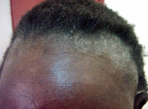 seborrheic dermatitis - Dandruff is considered a mild form of seborrheic dermatitis - In extreme cases you will notice not just flaking but extreme irritation with a lot of oil buildup on the scalp. Sebboric Dermitis Scalp, Seborrheic Dermitis On Face, Easy High Ponytail Hairstyles, Seborrheic Dermitis On Scalp, Easy High Ponytail, Dry Scalp Remedy, Ponytail Hack, Dry Flaky Scalp, Easy Ponytail