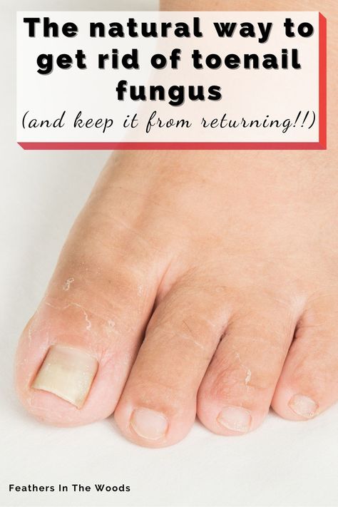 The absolute best natural remedy for toenail fungus. Don't use harsh chemicals on your delicate nails! Treat your nail fungus naturally and get rid of it for good. Simple steps using a common essential oil to get rid of foot fungus and keep it from coming back. Nail Remedies, Fingernail Fungus, Toenail Fungus Remedies, Nail Fungus Remedy, Nail Infection, Fungal Nail, Ingrown Toe Nail, Toenail Fungus, Nail Fungus