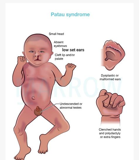 Nicu Nurse Education, Pediatric Nursing Study, Patau Syndrome, Medical Diagrams, Med School Study, Learn Biology, Medical Mnemonics, Student Midwife, Dentistry Student