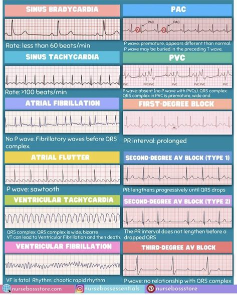 Ekg Interpretation, Nurse Skills, Nursing School Essential, Nursing Study Guide, Vet Medicine, Nurse Study Notes, Nursing Student Tips, Medical Student Study, Cardiac Nursing