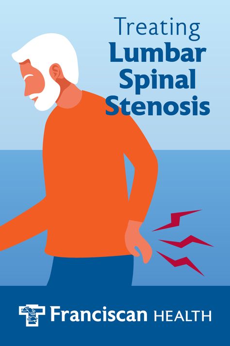 Vertiflex For Lumbar Spinal Stenosis | Franciscan Health Stenosis Of The Spine, Stenosis Exercises, Sciatic Nerve Stretches, Nerve Anatomy, Spinal Fusion, Piriformis Syndrome, Spinal Nerve, Pinched Nerve, Neck Exercises