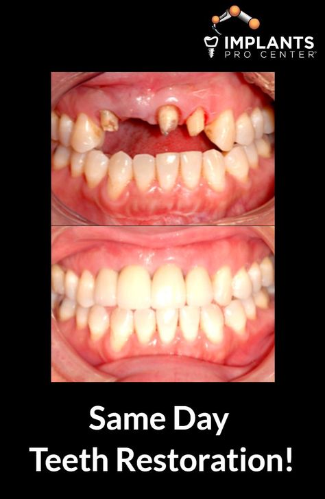 Teeth Composite, Broken Teeth, How To Remove Warts, Baby Tooth Decay, Homemade Garden Decorations, Benefits Of Dental Implants, Remove Warts, Regrow Tooth Enamel Heal Cavities, Best Mouthwash