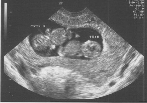 Twins Ultrasound, Twin Baby Boys, Baby Ultrasound, Ultrasound Pictures, Twin Pregnancy, Asian Babies, Foto Baby, Twin Boys, Excuse Me