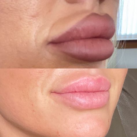 Filler Migration Lips, Aesthetic Treatments, Beauty Clinic, Lip Fillers, Picture This, One Pic, Period, Look At, The First