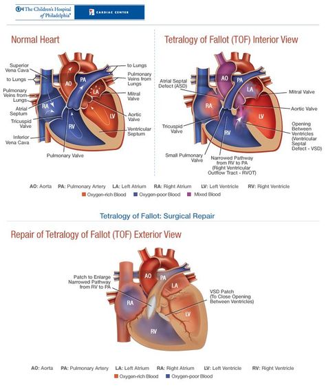 Tetralogy of Fallot (TOF) and its repair by CHOP Tetralogy Of Fallot, Chd Mom, Obstetrics Nursing, Heart Structure, Clara Barton, Nurse Teaching, Heart Stuff, Heart Warrior, Mitral Valve