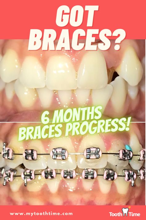 Check out this amazing progress in only 6 months wearing braces! Dental Braces, Braces, 6 Months, Quick Saves