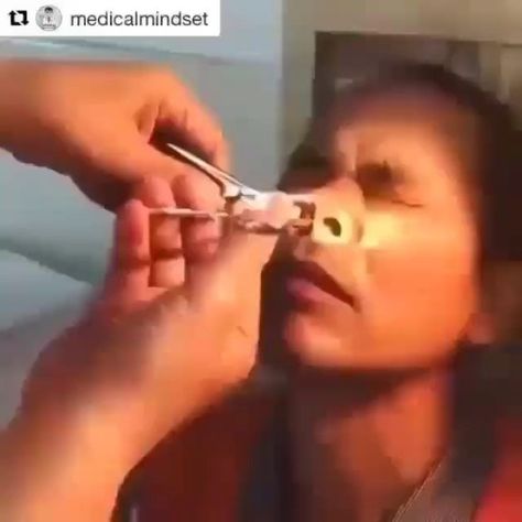 DO IT YOURSELF 𝙀𝙋𝙄𝘾 on Instagram: "Watch till end...😳😳 can you watch this type of satisfying video all day..😍😍 Follow @pimple__pop . . Dm us for credits or post removel. All credits goes to respacted creaters. #pimplepoppervids #pimple #pimples #whitehead #whiteheads #blackhead #blackheads #cyst #pimple #pimples #acne #whitehead #blackhead #blackheads #whiteheads #botfly #drpimplepopper #zit #blackheadremoval #pimplepopping #pimplepopper #pimplesolution #blackheads #whitehead #reels #rep Splinter Removal Video, Pore Cleaning Videos, Cysts Popping Videos, Zit Popping Video Faces, Big Zits, Satisfying Zit Popping Videos, Nose Pimples, Squeezing Blackheads, Pimple Pop