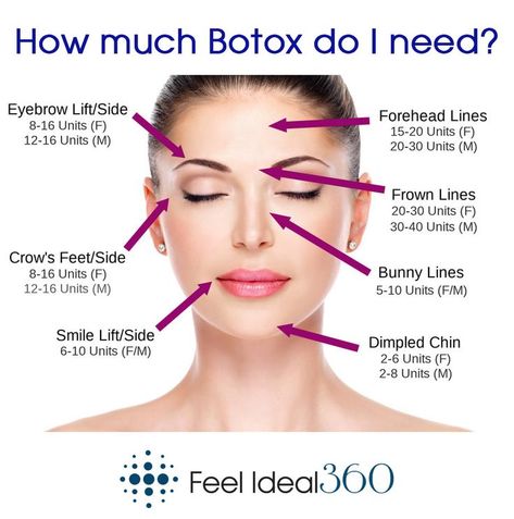 Units Of Botox Per Area, Botox Dos And Donts, Botox Units Needed, Facial Botox Areas, How Many Units Of Botox Do I Need, Botox Areas On Face, Where To Get Botox On Face, Botox Units, Botox For Sweating