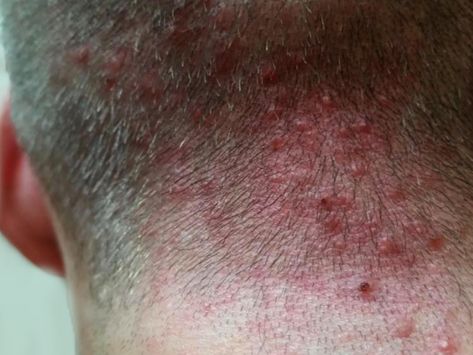 Scalp folliculitis can appear anywhere on the body that there are hair follicles, so it can look different depending on whether it's on the scalp, the chin, the back, upper arms, chest or elsewhere! Newborn Acne, Scalp Bumps, Fake Freckles, Acne Vulgaris, Body Acne, Maintaining Healthy Hair, A Haircut, Face Acne, Skin Clinic