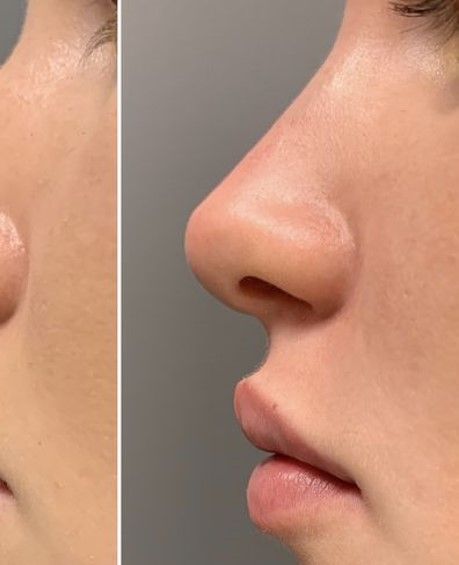 Nose Job Inspiration Natural, Perfect Nose Front View, Nose Job Inspo, Natural Nose Job, Dream Nose, Nose Aesthetic, Nose Profile, Nose Types, Cute Nose