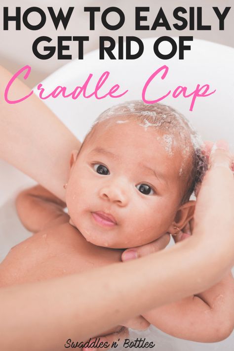 Thrush is the common term for a yeast infection that most often affects both baby and nursing mothers. It can even cause a disruption in breastfeeding. Luckily, it can be treated at home wit.... Baby Cradle Cap, Cradle Cap, Newborn Hacks, Pumping Moms, Baby Cradle, Baby Sleep Problems, Gerber Baby, Baby Arrival, After Baby