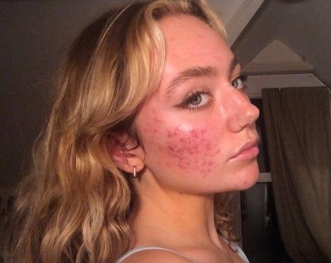 Pretty People With Acne, Girl With Acne, Acne Journey, Acne Positivity, Acne Beauty, Bad Acne, Get Rid Of Acne, Rid Of Acne, Bare Beauty