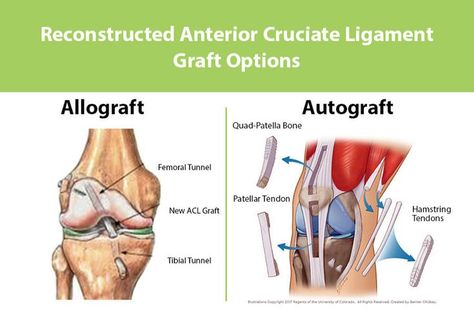 Physiotherapy Notes, Acl Surgery Recovery, Stiff Knee, Acl Rehab, Acl Reconstruction Surgery, Acl Recovery, Meniscal Tear, Acl Surgery, Anterior Cruciate Ligament