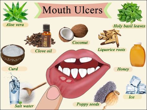 mouth uclers Remedy For Mouth Ulcers, Mouth Ulcer Remedies, Ulcer Remedies, Ulcer Remedies Mouth, Canker Sore Remedy, Mouth Ulcer, Best Cough Remedy, Mouth Care, Canker Sore