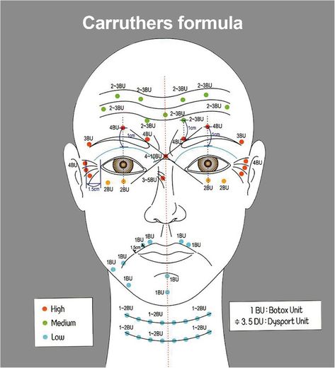 Face Diagram, Botox Injection Sites, Botox Training, Facial Injections, Botox Injection, Botox Lips, Aesthetic Dermatology, Botox Cosmetic, Botulinum Toxin