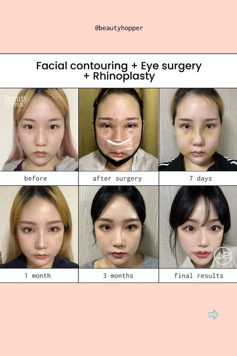 #plasticsurgeryinkorea #plasticsurgerykorea #plasticsurgeryconcierge #medicaltourismkorea #koreanplasticsurgery #plasticsurgerybeforeandafter #beautyhopper #doubleeyelidsurgery #rhinoplasty #vlinesurgery #rhinoplastykorea #seoulplasticsurgery #koreavlog #koreatrip #koreanplasticsurgery #koreaplasticsurgery #doubleeyelid #revisionrhinoplasty #asianrhinoplasty #facialcontouring Korean Nose Job, Facial Contouring Surgery, Korean Nose, V Line Surgery, Trip To Korea, Plastic Surgery Korea, Korean Plastic Surgery, Facial Contouring, Double Eyelid