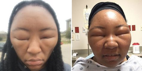 Health Vlogger Shares Photos After Scary Allergic Reaction to Henna Hair Dye Hair Dye Allergy, Boxed Hair Color, Henna Hair Dye, Vegan Hair Dye, Henna Hair, New News, Tattoo Henna, Vegan Hair, Permanent Hair Dye