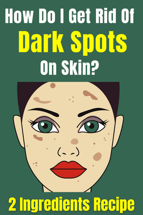 These ingredients might help to reduce age spots naturally: babchi, and kakadu plum. #skin #sunspots #lighterskin #darkspots #skincare #darkspots #agespots #healthyskin #NaturalBeauty Best Age Spot Remover, Darkspots Skincare, Sunspots On Face, Dark Spot Removal, Age Spots On Face, Age Spot Removal, Dark Spots On Face, Dark Spots On Skin, Lighten Dark Spots