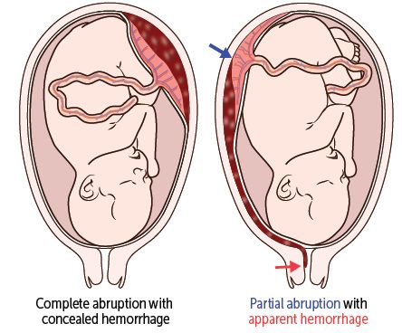 Repro (Pregnancy Complications) Flashcards | Memorang Placenta Abruption, Benefits Of Placenta Encapsulation, Abruptio Placenta Nursing, Anterior Placenta, Premature Atrial Contraction, Placenta Accreta, Choice Questions, Free Apps