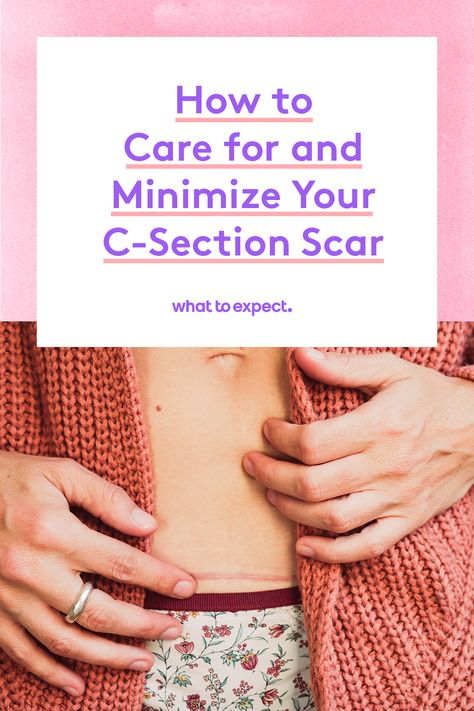 Tricks to help your incision heal properly and curb scarring. Healing From C Section, C Section Scar, Scar Remedies, Cesarean Delivery, C Section Scars, Maternity Photo Shoots, Happy Pregnancy, Healing Tips, Pregnant Friends