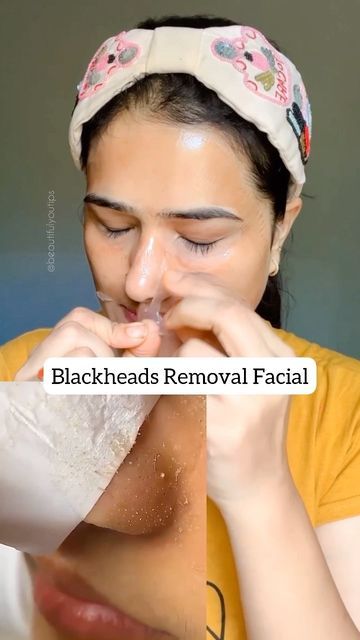 How To Clear Whiteheads On Nose, How To Get Rid Of Whiteheads On Chin, Face Mask For White Heads, Mask For Nose Blackheads, Face Blackheads Removal, How To Get Rid Of Chin Blackheads, How To Remove Blackheads And Whiteheads, Get Rid Of White Heads On Nose, Peal Off Face Mask Homemade